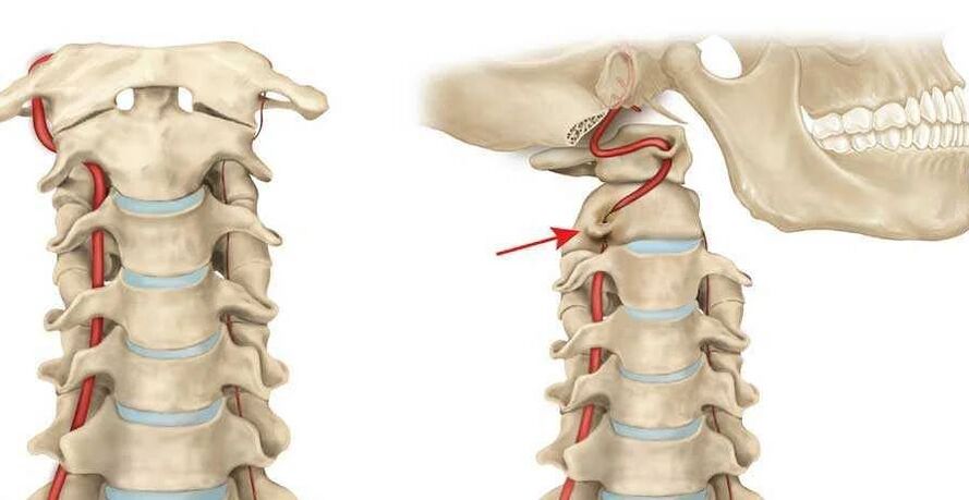 vertebral arter sendromu