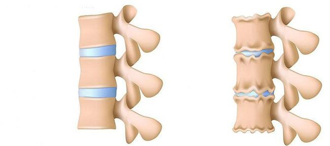 Osteokondroz nedir