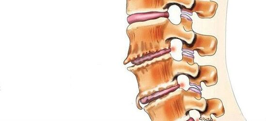 Spondiloz nedir