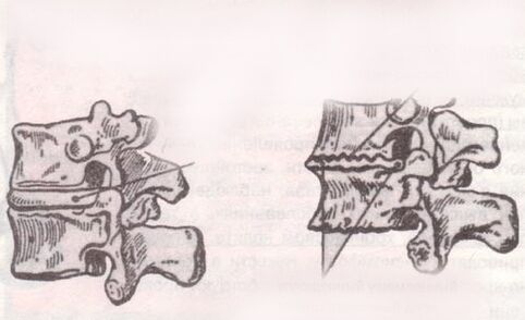İntervertebral disk sağlıklı ve lomber osteokondroz ile