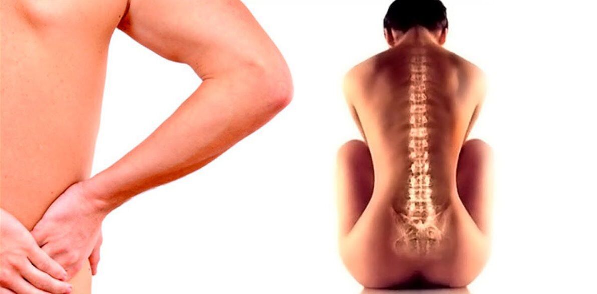 Osteokondroz nedeniyle bel ağrısı