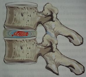 Osteokondrozun ilk aşaması