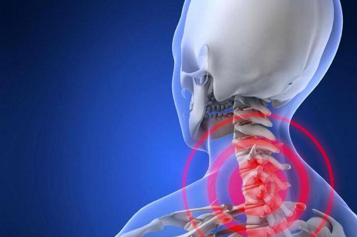 Boyunda ağrı çekmek servikal osteokondrozun erken bir belirtisidir